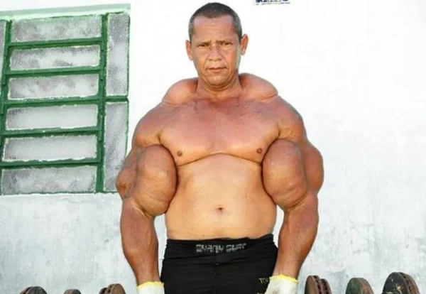 Історія з Jam Press (Помер бодібілдер Popeye). Фото: Арліндо де Соуза. Бодібілдер на прізвисько «Popeye» помер у віці 55 років. Бодібілдер на прізвисько «Popeye», відомий тим, що нарощує свої біцепси за допомогою хімічних речовин, помер у віці 55 років. Повідомляється, що Арліндо де Соуза страждав від поліорганної недостатності та помер у лікарні вчора (14 січня). Він здобув популярність після того, як ввів собі в руки саморобний синтол, щоб вони виглядали більшими. Кажуть, що Арліндо мав найбільші руки в Бразилії, і він став популярною фігурою на національному телебаченні. На батьківщині його називали «бразильським Popeye». Його штучно збільшені біцепси сягали вражаючих 29 дюймів, як повідомляє NeedToKnow. 55-річний чоловік, який жив зі своєю матір'ю в прибережному місті Олінда, був госпіталізований з проблемою нирок на Різдво. Племінниця Арліндо сказала, що одна з його нирок відмовила, що призвело до того, що його «легені наповнилися рідиною». Вона додала: «Він навіть не дістався до гемодіалізу, бо у нього сталася зупинка серця». Його родич додав, що родина ще не отримала свідоцтва про смерть, але вони розуміють, що його смерть сталася «через поліорганну недостатність». В оголошенні в соціальних мережах його назвали «хорошим хлопцем, корисним, грайливим у своїх позах і улюбленим громадою». Лікарі раніше попереджали Арліндо про небезпеку частих ін'єкцій синтолу в руки, і він змінив свою думку щодо цієї практики після смерті близького друга Пауліньо. Інтернет-ікона, більш відомий в Інтернеті як Арліндо Аномалія, сказав тоді: «[Пауліньо] приймав його, я приймав, але він перевищив межу. Я раджу всім ніколи не приймати цю олію. Я дуже переживав його смерть. Я перестав приймати її, та й інші речі також. Завжди є бажання почати спочатку, але мені вдається контролювати себе». Арліндо, у якого було майже 30 000 підписників у Facebook, додав: «Деякі люди врешті-решт втратять руку, іншим знадобиться операція, деякі можуть навіть втратити життя». КІНЕЦЬ