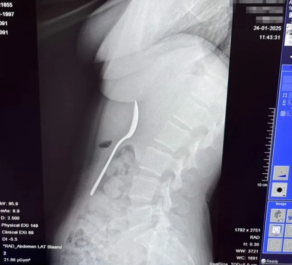 Історія з Jam Press (Жінка ковтає ложку). На фото: рентгенівський знімок ложки всередині Реймі Амелінкс після випадкового ковтання. «Я випадково проковтнула 17-сантиметрову ложку, поки їла йогурт? Мені було надто соромно сказати своєму хлопцеві». Жінка випадково проковтнула 17-сантиметрову ложку, коли її собака стрибнув їй на коліна, поки вона їла йогурт. Реймі Амелінкс сказала, що їй довелося вибирати між «задихом» та «ковтанням ложки». Вона відчула, як інструмент «плавно ковзає мені в шлунок». 28-річна жінка розповіла, що сиділа на дивані з йогуртом, коли її енергійна угорська візла на ім'я Марлі раптово стрибнула на неї. «Я поклала ложку до рота, щоб звільнити руки та відповісти на повідомлення», — розповіла Реймі, яка родом з Румста в Бельгії, «Що таке варення». «Саме тоді Марлі вирішив стрибнути на мене. «Я так злякалася, що різко відкинула голову назад, і перш ніж я це усвідомила, ложка застрягла у мене в горлі. Я встала і почала панікувати». Спочатку Реймі, яка працює медичним представником, спробувала вийняти ложку рукою. «Але все сталося так швидко, що вона або ковтнула, або захлинулася», – сказала вона. Коли її хлопець повернувся з роботи, вона сказала, що їй було надто соромно сказати йому, тому вона «вдала, що нічого не сталося». «Мені зовсім не було погано», тому я одразу нічого про це не сказала. «Лише після вечері я зрозуміла, що це насправді досить серйозно. «У моєму шлунку була 17-сантиметрова ложка. В інтернеті скрізь говорили одне й те саме: негайно до відділення невідкладної допомоги. Тільки тоді я зрозуміла, наскільки це може бути небезпечно». Лікарі сказали їй, що ложка занадто велика, щоб виходити природним шляхом, тому їй довелося повернутися додому та чекати, поки можна буде призначити гастроскопію. Реймі сказала: «Тієї ночі було важко, я відчувала, як ложка рухається, іноді навіть між ребрами. Це було справді жахливо. Я відчувала здуття живота та нудоту, і я не могла їсти, не відчуваючи дивних відчуттів. Спати було важко, бо кожна позиція нагадувала мені ложку в шлунку». Приладдя видалили через два дні під місцевою анестезією. «Мені не дозволяли ковтати, поки його витягували», – сказала Реймі. «Їм довелося обертати його в шлунку, що спричинило невелику шлункову кровотечу. Це було неприємно, але я відчула справжнє полегшення, коли його витягли». Вона додала: «Я так рада, що ложку врешті-решт видалили за допомогою гастроскопії, і що їм не довелося хірургічно розрізати мій шлунок». Через кілька годин ковтальниці ложки дозволили повернутися додому. «Після видалення я швидко одужала», – сказала вона. «У мене боліло горло через пошкодження стравоходу, було кілька незначних шлункових кровотеч і деякий час була чутлива шлунок, але без постійних пошкоджень. «Однак я здобула довічну репутацію «тієї дівчини з ложкою»?» Вона додала: «Наступного дня я повернулася до роботи, як завжди. Мої колеги не повірили мені, поки я не показала їм рентгенівський знімок». Незважаючи на неприємний досвід, Реймі вирішила зберегти ложку, про яку йде мова, як пам’ять. «Мій хлопець хоче перетворити її на витвір мистецтва», – сказала вона. «Він ще не знає точно, що саме, але це точно буде унікальний твір. «Це найменше, чого заслуговує така пригода». Реймі поділилася порадами для таких же любителів собак та йогурту — або тих, хто думає про те, щоб відмовитися від використання столового прибору для надсилання повідомлень. Вона сказала: «Захоплені собаки + їжа на колінах = зона ризику. Навчіть їх команді «чекати» або «тихо» для моментів стрибка. Для тих, хто їсть йогурт: не їжте, тримаючи столові прибори повністю в роті. Не виконуйте багато завдань одночасно з тваринами та уникайте переляку від стрибків та сміху з повним ротом. Якщо ви проковтнули щось, чого насправді там не повинно бути: негайно зверніться за медичною допомогою. Збентеження тимчасове, внутрішні пошкодження — ні». Реймі додала: «Це дивна історія, але зі щасливим кінцем — і легендарний анекдот для вечірок». КІНЕЦЬ ПРИМІТКА РЕДАКТОРА: Ліцензія на використання відео: (НЕВИКЛЮЧНА) Ми отримали невиключну ліцензію від власника авторських прав. Копія ліцензії доступна за запитом. Обмеження відео: Немає.