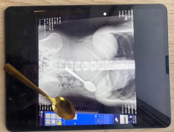 Історія з Jam Press (Жінка ковтає ложку). На фото: рентгенівський знімок ложки всередині Реймі Амелінкс після випадкового ковтання. «Я випадково проковтнула 17-сантиметрову ложку, поки їла йогурт? Мені було надто соромно сказати своєму хлопцеві». Жінка випадково проковтнула 17-сантиметрову ложку, коли її собака стрибнув їй на коліна, поки вона їла йогурт. Реймі Амелінкс сказала, що їй довелося вибирати між «задихом» та «ковтанням ложки». Вона відчула, як інструмент «плавно ковзає мені в шлунок». 28-річна жінка розповіла, що сиділа на дивані з йогуртом, коли її енергійна угорська візла на ім'я Марлі раптово стрибнула на неї. «Я поклала ложку до рота, щоб звільнити руки та відповісти на повідомлення», — розповіла Реймі, яка родом з Румста в Бельгії, «Що таке варення». «Саме тоді Марлі вирішив стрибнути на мене. «Я так злякалася, що різко відкинула голову назад, і перш ніж я це усвідомила, ложка застрягла у мене в горлі. Я встала і почала панікувати». Спочатку Реймі, яка працює медичним представником, спробувала вийняти ложку рукою. «Але все сталося так швидко, що вона або ковтнула, або захлинулася», – сказала вона. Коли її хлопець повернувся з роботи, вона сказала, що їй було надто соромно сказати йому, тому вона «вдала, що нічого не сталося». «Мені зовсім не було погано», тому я одразу нічого про це не сказала. «Лише після вечері я зрозуміла, що це насправді досить серйозно. «У моєму шлунку була 17-сантиметрова ложка. В інтернеті скрізь говорили одне й те саме: негайно до відділення невідкладної допомоги. Тільки тоді я зрозуміла, наскільки це може бути небезпечно». Лікарі сказали їй, що ложка занадто велика, щоб виходити природним шляхом, тому їй довелося повернутися додому та чекати, поки можна буде призначити гастроскопію. Реймі сказала: «Тієї ночі було важко, я відчувала, як ложка рухається, іноді навіть між ребрами. Це було справді жахливо. Я відчувала здуття живота та нудоту, і я не могла їсти, не відчуваючи дивних відчуттів. Спати було важко, бо кожна позиція нагадувала мені ложку в шлунку». Приладдя видалили через два дні під місцевою анестезією. «Мені не дозволяли ковтати, поки його витягували», – сказала Реймі. «Їм довелося обертати його в шлунку, що спричинило невелику шлункову кровотечу. Це було неприємно, але я відчула справжнє полегшення, коли його витягли». Вона додала: «Я так рада, що ложку врешті-решт видалили за допомогою гастроскопії, і що їм не довелося хірургічно розрізати мій шлунок». Через кілька годин ковтальниці ложки дозволили повернутися додому. «Після видалення я швидко одужала», – сказала вона. «У мене боліло горло через пошкодження стравоходу, було кілька незначних шлункових кровотеч і деякий час була чутлива шлунок, але без постійних пошкоджень. «Однак я здобула довічну репутацію «тієї дівчини з ложкою»?» Вона додала: «Наступного дня я повернулася до роботи, як завжди. Мої колеги не повірили мені, поки я не показала їм рентгенівський знімок». Незважаючи на неприємний досвід, Реймі вирішила зберегти ложку, про яку йде мова, як пам’ять. «Мій хлопець хоче перетворити її на витвір мистецтва», – сказала вона. «Він ще не знає точно, що саме, але це точно буде унікальний твір. «Це найменше, чого заслуговує така пригода». Реймі поділилася порадами для таких же любителів собак та йогурту — або тих, хто думає про те, щоб відмовитися від використання столового прибору для надсилання повідомлень. Вона сказала: «Захоплені собаки + їжа на колінах = зона ризику. Навчіть їх команді «чекати» або «тихо» для моментів стрибка. Для тих, хто їсть йогурт: не їжте, тримаючи столові прибори повністю в роті. Не виконуйте багато завдань одночасно з тваринами та уникайте переляку від стрибків та сміху з повним ротом. Якщо ви проковтнули щось, чого насправді там не повинно бути: негайно зверніться за медичною допомогою. Збентеження тимчасове, внутрішні пошкодження — ні». Реймі додала: «Це дивна історія, але зі щасливим кінцем — і легендарний анекдот для вечірок». КІНЕЦЬ ПРИМІТКА РЕДАКТОРА: Ліцензія на використання відео: (НЕВИКЛЮЧНА) Ми отримали невиключну ліцензію від власника авторських прав. Копія ліцензії доступна за запитом. Обмеження відео: Немає.