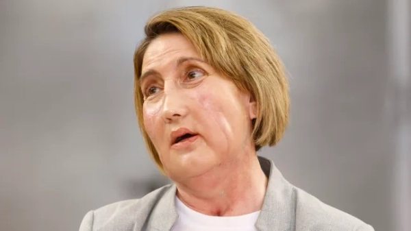 Жінці з хворобою плотоядства пересадили обличчя від донора, який отримав…