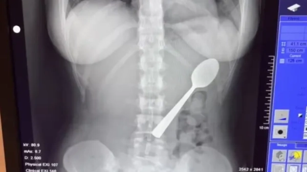 Історія з Jam Press (Жінка ковтає ложку). На фото: відео, на якому Реймі Амелінкс розповідає історію про те, як вона проковтнула ложку. «Я випадково проковтнула 17-сантиметрову ложку, коли їла йогурт? Мені було надто соромно розповісти своєму хлопцеві». Жінка випадково проковтнула 17-сантиметрову ложку, коли її собака стрибнув їй на коліна, поки вона їла йогурт. Реймі Амелінкс сказала, що їй довелося вибирати між «задихом» і «ковтанням ложки». Вона відчула, як інструмент «плавно ковзає мені в шлунок». 28-річна жінка розповіла, що сиділа на дивані з йогуртом, коли її енергійна угорська візла на ім'я Марлі раптово стрибнула на неї. «Я поклала ложку в рот, щоб звільнити руки та відповісти на повідомлення», – розповіла Реймі, яка родом з Румста в Бельгії, «Що таке варення?». «Саме тоді Марлі вирішила стрибнути на мене. «Я так злякалася, що різко відкинула голову назад, і перш ніж я це усвідомила, ложка застрягла у мене в горлі. «Я встала і почала панікувати». Спочатку Реймі, яка працює медичним представником, спробувала вийняти ложку рукою. «Але все сталося так швидко, що це було або ковтання, або задуха», – сказала вона. Коли її хлопець повернувся з роботи, вона сказала, що їй було надто соромно сказати йому, тому вона «вдала, що нічого не сталося». «Мені зовсім не було погано», тому я одразу нічого про це не сказала. «Лише після вечері я зрозуміла, що це насправді досить серйозно. «У моєму шлунку була 17-сантиметрова ложка. В інтернеті скрізь казали одне й те саме: негайно йдіть до відділення невідкладної допомоги. Тільки тоді я зрозуміла, наскільки це може бути небезпечно». Лікарі сказали їй, що ложка занадто велика, щоб вивести її природним шляхом, тому їй довелося повернутися додому та чекати, поки можна буде призначити гастроскопію. Реймі сказала: «Та ніч була важкою, я відчувала, як ложка рухається, іноді навіть між ребрами. Це було справді жахливо». «Я відчувала здуття живота та нудоту, і не могла їсти, не відчуваючи дивних відчуттів. Спати було важко, бо кожна постава нагадувала мені ложку в шлунку». Приладдя видалили через два дні під місцевою анестезією. «Мені не дозволяли ковтати, поки його витягували», – сказала Реймі. «Їм довелося обертати його в шлунку, що спричинило невелику шлункову кровотечу. Це було неприємно, але я відчула справжнє полегшення, коли його витягли». Вона додала: «Я так рада, що ложку врешті-решт видалили за допомогою гастроскопії, і що їм не довелося хірургічно розрізати мій шлунок». Через кілька годин ковтальниці ложки дозволили повернутися додому. «Після видалення я швидко одужала», – сказала вона. «У мене боліло горло через пошкодження стравоходу, було кілька незначних шлункових кровотеч і деякий час був чутливий шлунок, але без постійних пошкоджень. «Однак я здобула довічну репутацію «тієї дівчини з ложкою»». Вона додала: «Наступного дня я повернулася до роботи, як завжди. Мої колеги не повірили мені, доки я не показала їм рентгенівський знімок». Незважаючи на неприємний досвід, Реймі вирішила зберегти ложку, про яку йде мова, як пам’ять. «Мій хлопець хоче перетворити її на витвір мистецтва», – сказала вона. «Він ще не знає точно, що саме, але це точно буде унікальний твір. «Це найменше, чого заслуговує така пригода». Реймі поділилася порадами для таких же любителів собак та йогурту — або тих, хто думає про те, щоб відмовитися від використання столового прибору для надсилання повідомлень. Вона сказала: «Захоплені собаки + їжа на колінах = зона ризику. Навчіть їх команді «чекати» або «тихо» для моментів стрибка. Для тих, хто їсть йогурт: не їжте, тримаючи столові прибори повністю в роті. Не виконуйте багато завдань одночасно з тваринами та уникайте переляку від стрибків та сміху з повним ротом. Якщо ви проковтнули щось, чого насправді там не повинно бути: негайно зверніться за медичною допомогою. Збентеження тимчасове, внутрішні пошкодження — ні». Реймі додала: «Це дивна історія, але зі щасливим кінцем — і легендарний анекдот для вечірок». КІНЕЦЬ ПРИМІТКА РЕДАКТОРА: Ліцензія на використання відео: (НЕВИКЛЮЧНА) Ми отримали невиключну ліцензію від власника авторських прав. Копія ліцензії доступна за запитом. Обмеження відео: Немає.