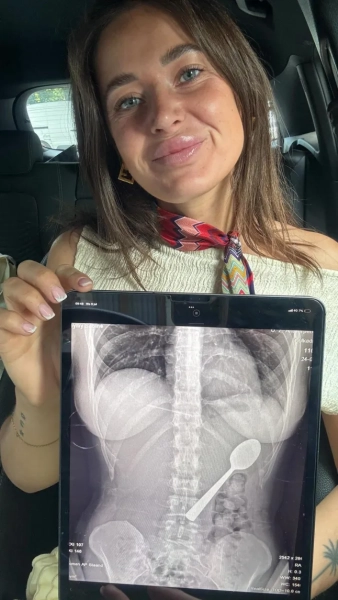 Історія з Jam Press (Жінка ковтає ложку). На фото: Реймі Амелінкс показує рентгенівський знімок ложки всередині себе після того, як випадково її проковтнула. «Я випадково проковтнула 17-сантиметрову ложку, коли їла йогурт? Мені було надто соромно сказати своєму хлопцеві». Жінка випадково проковтнула 17-сантиметрову ложку, коли її собака стрибнув їй на коліна, поки вона їла йогурт. Реймі Амелінкс сказала, що їй довелося вибирати між «задихом» і «ковтанням ложки». Вона відчула, як інструмент «плавно ковзає мені в шлунок». 28-річна жінка розповіла, що сиділа на дивані з йогуртом, коли її енергійна угорська візла на ім'я Марлі раптово стрибнула на неї. «Я поклала ложку до рота, щоб звільнити руки та відповісти на повідомлення», — розповіла Реймі, яка родом з Румста в Бельгії, «Що таке варення?». «Саме тоді Марлі вирішив стрибнути на мене. «Я так злякалася, що різко відкинула голову назад, і перш ніж я це усвідомила, ложка застрягла у мене в горлі. Я встала і почала панікувати». Спочатку Реймі, яка працює медичним представником, спробувала вийняти ложку рукою. «Але все сталося так швидко, що вона або ковтнула, або захлинулася», – сказала вона. Коли її хлопець повернувся з роботи, вона сказала, що їй було надто соромно сказати йому, тому вона «вдала, що нічого не сталося». «Мені зовсім не було погано», тому я одразу нічого про це не сказала. «Лише після вечері я зрозуміла, що це насправді досить серйозно. «У моєму шлунку була 17-сантиметрова ложка. В інтернеті скрізь говорили одне й те саме: негайно до відділення невідкладної допомоги. Тільки тоді я зрозуміла, наскільки це може бути небезпечно». Лікарі сказали їй, що ложка занадто велика, щоб виходити природним шляхом, тому їй довелося повернутися додому та чекати, поки можна буде призначити гастроскопію. Реймі сказала: «Тієї ночі було важко, я відчувала, як ложка рухається, іноді навіть між ребрами. Це було справді жахливо. Я відчувала здуття живота та нудоту, і я не могла їсти, не відчуваючи дивних відчуттів. Спати було важко, бо кожна позиція нагадувала мені ложку в шлунку». Приладдя видалили через два дні під місцевою анестезією. «Мені не дозволяли ковтати, поки його витягували», – сказала Реймі. «Їм довелося обертати його в шлунку, що спричинило невелику шлункову кровотечу. Це було неприємно, але я відчула справжнє полегшення, коли його витягли». Вона додала: «Я так рада, що ложку врешті-решт видалили за допомогою гастроскопії, і що їм не довелося хірургічно розрізати мій шлунок». Через кілька годин ковтальниці ложки дозволили повернутися додому. «Після видалення я швидко одужала», – сказала вона. «У мене боліло горло через пошкодження стравоходу, було кілька незначних шлункових кровотеч і деякий час була чутлива шлунок, але без постійних пошкоджень. «Однак я здобула довічну репутацію «тієї дівчини з ложкою»?» Вона додала: «Наступного дня я повернулася до роботи, як завжди. Мої колеги не повірили мені, поки я не показала їм рентгенівський знімок». Незважаючи на неприємний досвід, Реймі вирішила зберегти ложку, про яку йде мова, як пам’ять. «Мій хлопець хоче перетворити її на витвір мистецтва», – сказала вона. «Він ще не знає точно, що саме, але це точно буде унікальний твір. «Це найменше, чого заслуговує така пригода». Реймі поділилася порадами для таких же любителів собак та йогурту — або тих, хто думає про те, щоб відмовитися від використання столового прибору для надсилання повідомлень. Вона сказала: «Захоплені собаки + їжа на колінах = зона ризику. Навчіть їх команді «чекати» або «тихо» для моментів стрибка. Для тих, хто їсть йогурт: не їжте, тримаючи столові прибори повністю в роті. Не виконуйте багато завдань одночасно з тваринами та уникайте переляку від стрибків та сміху з повним ротом. Якщо ви проковтнули щось, чого насправді там не повинно бути: негайно зверніться за медичною допомогою. Збентеження тимчасове, внутрішні пошкодження — ні». Реймі додала: «Це дивна історія, але зі щасливим кінцем — і легендарний анекдот для вечірок». КІНЕЦЬ ПРИМІТКА РЕДАКТОРА: Ліцензія на використання відео: (НЕВИКЛЮЧНА) Ми отримали невиключну ліцензію від власника авторських прав. Копія ліцензії доступна за запитом. Обмеження відео: Немає.