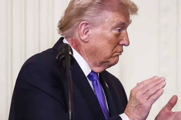 epa12790483 Президент США Дональд Трамп відвідує церемонію вручення почесної медалі у Східній кімнаті Білого дому у Вашингтоні, округ Колумбія, США, 2 березня 2026 року. У президента червоний висип на правій стороні шиї. EPA/JIM LO SCALZO / POOL