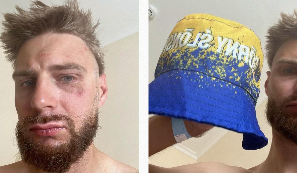 В Чехії побили поляка, якого прийняли за українця через кольори на панамці